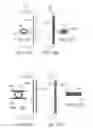 Fig. 16 - Methods and systems for establishing retrograde carotid arterial blood flow