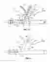 Fig. 09 - Device and methods for transvascular tumor embolization with integrated flow regulation