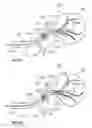 Fig. 35 - Device and methods for transvascular tumor embolization with integrated flow regulation