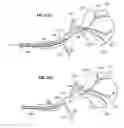 Fig. 41 - Device and methods for transvascular tumor embolization with integrated flow regulation