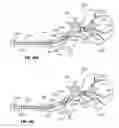 Fig. 44 - Device and methods for transvascular tumor embolization with integrated flow regulation