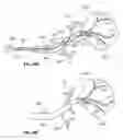 Fig. 45 - Device and methods for transvascular tumor embolization with integrated flow regulation