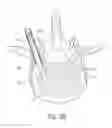 Fig. 07 - Systems for treating a vertebral body