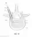 Fig. 08 - Systems for treating a vertebral body