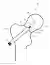 Fig. 01 - FRACTURE TREATMENT DEVICE