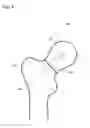 Fig. 05 - FRACTURE TREATMENT DEVICE