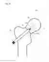 Fig. 06 - FRACTURE TREATMENT DEVICE