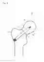 Fig. 07 - FRACTURE TREATMENT DEVICE
