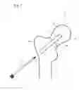 Fig. 08 - FRACTURE TREATMENT DEVICE