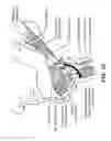 Fig. 09 - Method for modifying larynx position by trans-positioning muscle and electrode stimulation