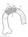 Fig. 01 - EMBOLI GUARDING DEVICE
