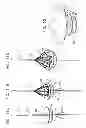 Fig. 33 - MINIMALLY INVASIVE SURGICAL TECHNIQUES