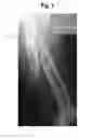 Fig. 02 - Channeled bone plate and methods for implanting the same