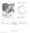 Fig. 14 - Method for low-voltage termination of cardiac arrhythmias by effectively unpinning anatomical reentries