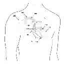 Fig. 01 - Metrics of electrical dyssynchrony and electrical activation patterns from surface ECG electrodes