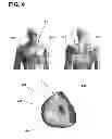 Fig. 06 - Implantable electrode location selection