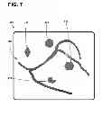 Fig. 09 - Implantable electrode location selection