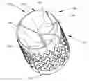 Fig. 01 - EXPANDABLE SUPPORTIVE ENDOLUMINAL STENT GRAFT
