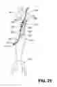 Fig. 22 - EXPANDABLE SUPPORTIVE ENDOLUMINAL STENT GRAFT