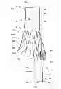 Fig. 01 - Endovascular graft with an expanded lumen at a bifurcation