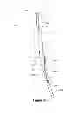 Fig. 07 - Endovascular graft with an expanded lumen at a bifurcation