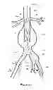 Fig. 08 - Endovascular graft with an expanded lumen at a bifurcation