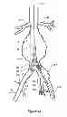 Fig. 09 - Endovascular graft with an expanded lumen at a bifurcation