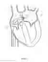 Fig. 07 - Mitral valve spacer and system and method for implanting the same