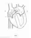 Fig. 08 - Mitral valve spacer and system and method for implanting the same