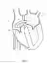 Fig. 09 - Mitral valve spacer and system and method for implanting the same