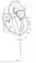 Fig. 22 - Mitral valve spacer and system and method for implanting the same