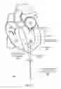 Fig. 43 - Mitral valve spacer and system and method for implanting the same