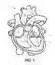 Fig. 02 - TRANSCATHETER MITRAL VALVE AND DELIVERY SYSTEM