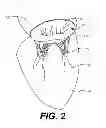 Fig. 03 - TRANSCATHETER MITRAL VALVE AND DELIVERY SYSTEM