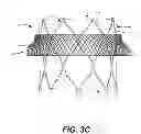 Fig. 05 - TRANSCATHETER MITRAL VALVE AND DELIVERY SYSTEM