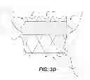 Fig. 06 - TRANSCATHETER MITRAL VALVE AND DELIVERY SYSTEM