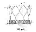 Fig. 08 - TRANSCATHETER MITRAL VALVE AND DELIVERY SYSTEM