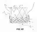 Fig. 09 - TRANSCATHETER MITRAL VALVE AND DELIVERY SYSTEM