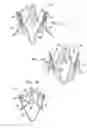 Fig. 03 - Valve suturing and implantation procedures