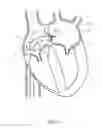 Fig. 07 - Mitral valve spacer and system and method for implanting the same