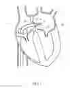 Fig. 08 - Mitral valve spacer and system and method for implanting the same