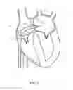 Fig. 09 - Mitral valve spacer and system and method for implanting the same