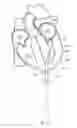 Fig. 22 - Mitral valve spacer and system and method for implanting the same