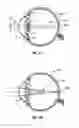 Fig. 02 - Limited echelette lens, systems and methods