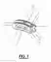 Fig. 02 - Intervertebral implant devices