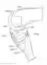 Fig. 01 - Posterior stabilized insert trial with adjustable post