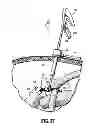 Fig. 30 - Flexible surgical stapler with motor in the head