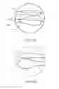 Fig. 108 - Container having a rim or other feature encapsulated by or formed from injection-molded material