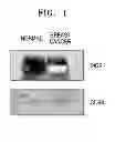 Fig. 02 - Method for diagnosing breast cancer by detection of polymeric immunoglobulin receptor in vesicles isolated from patients