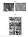 Fig. 10 - Vascular Tumor Markers
